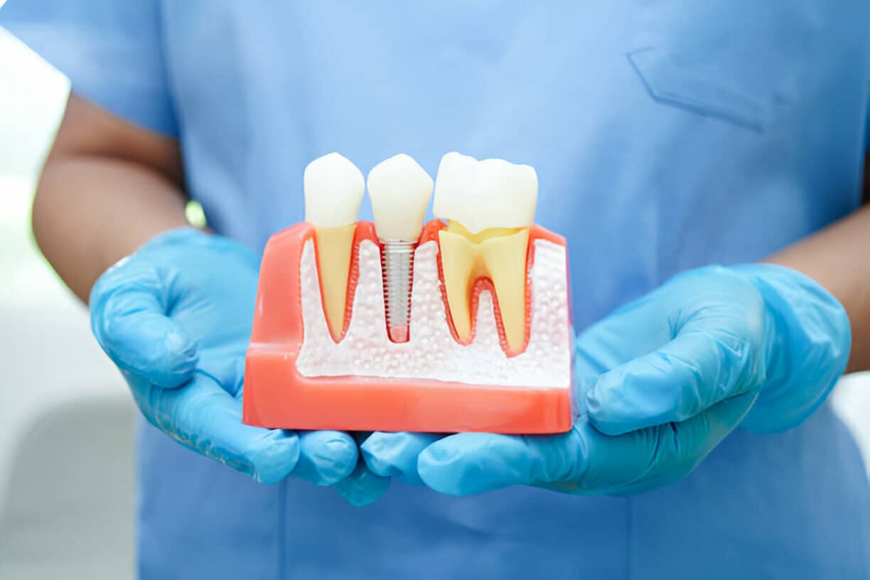 Things To Know Before Getting Dental Implants