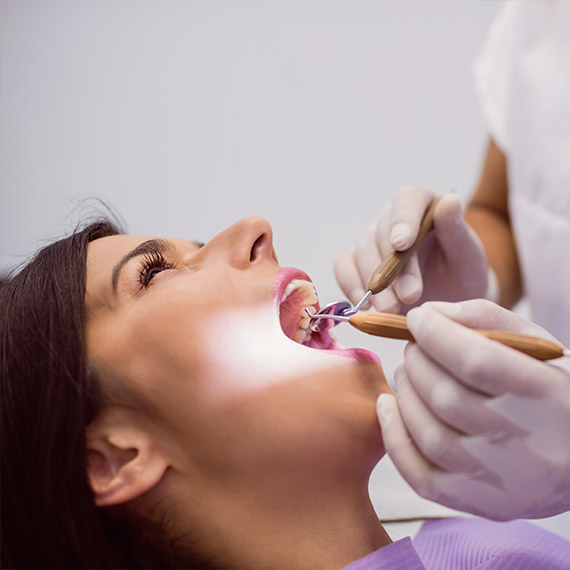Dental veneers in Vancouver