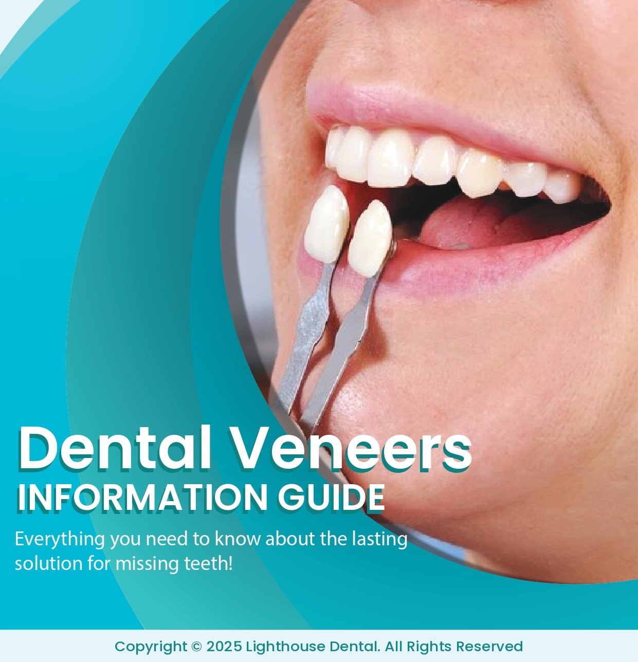 dental veneers information