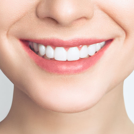 Dental veneers in Vancouver, BC