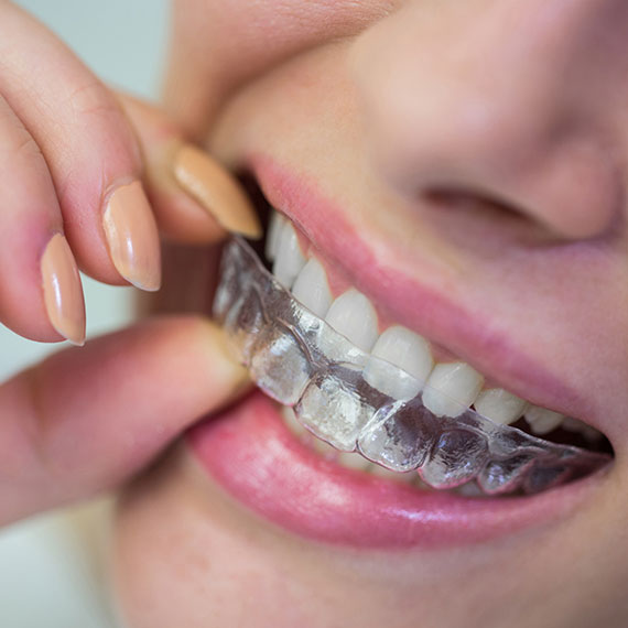 Invisalign near you