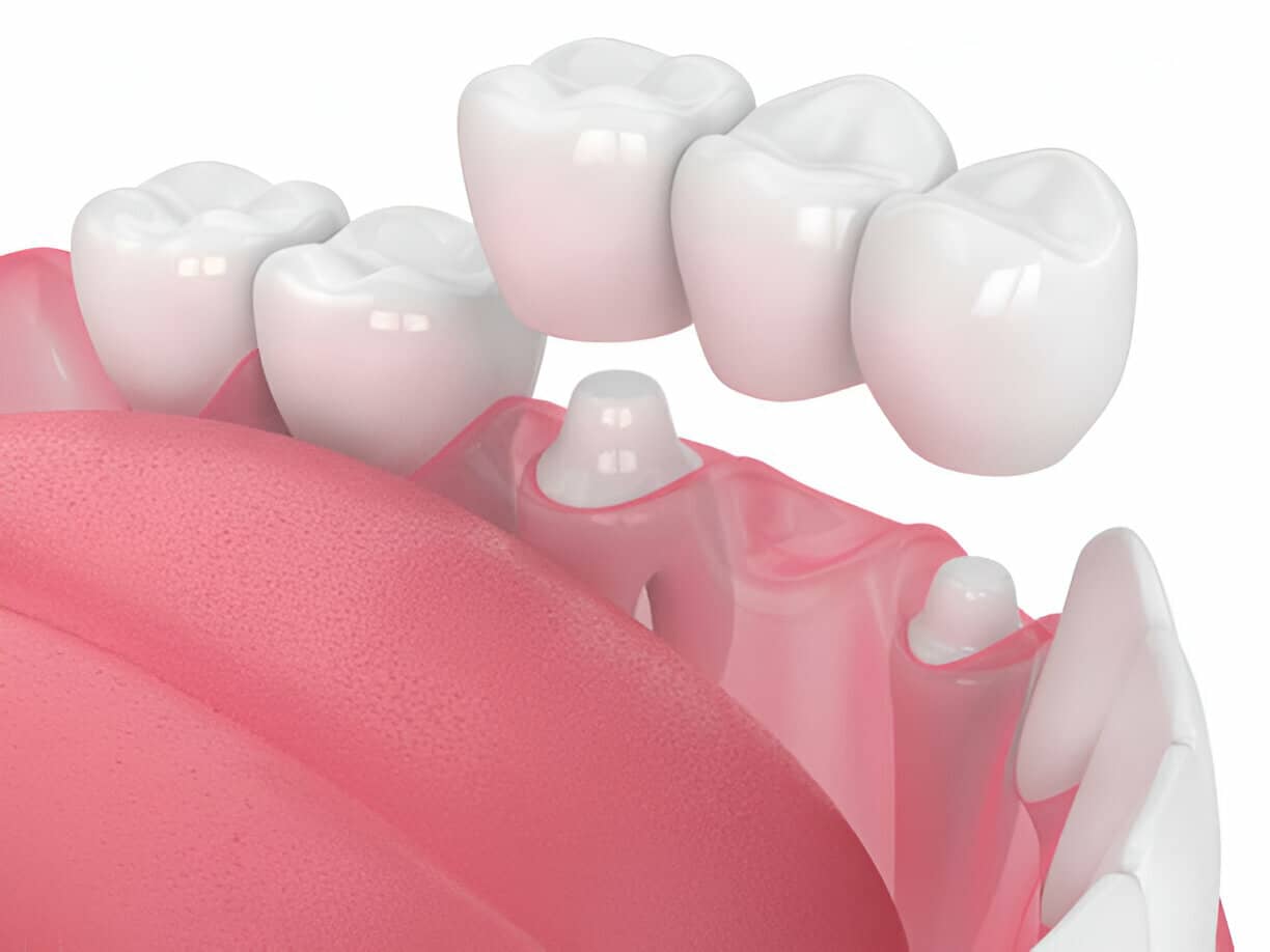 Is a Dental Crown Right for You? Find Out Now!