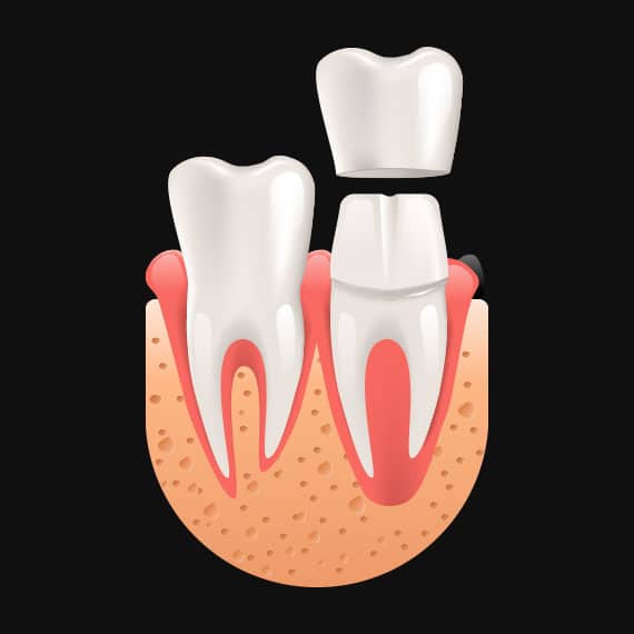 Metal-Free Dental Crowns