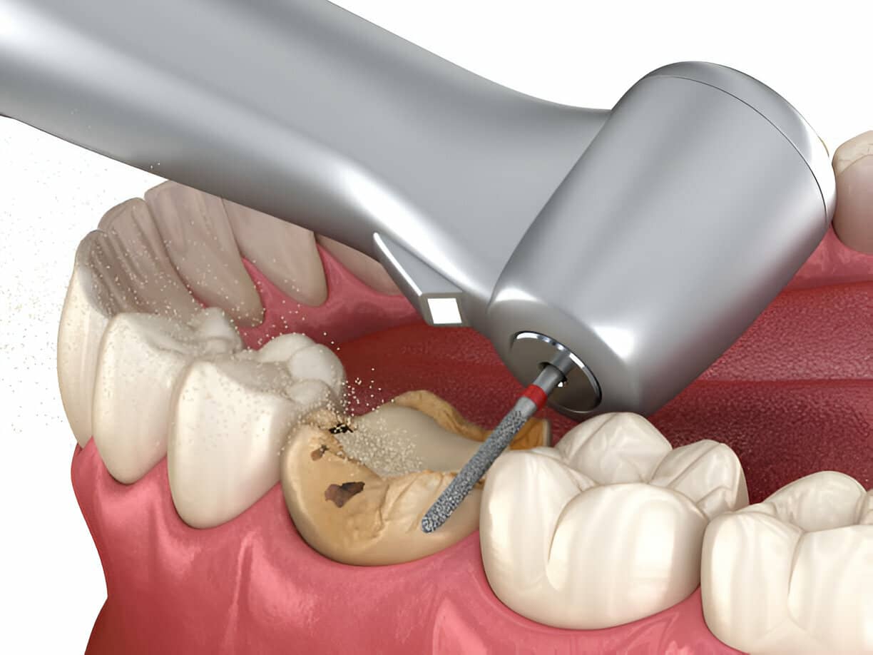 Periodontist for pinhole technique near you