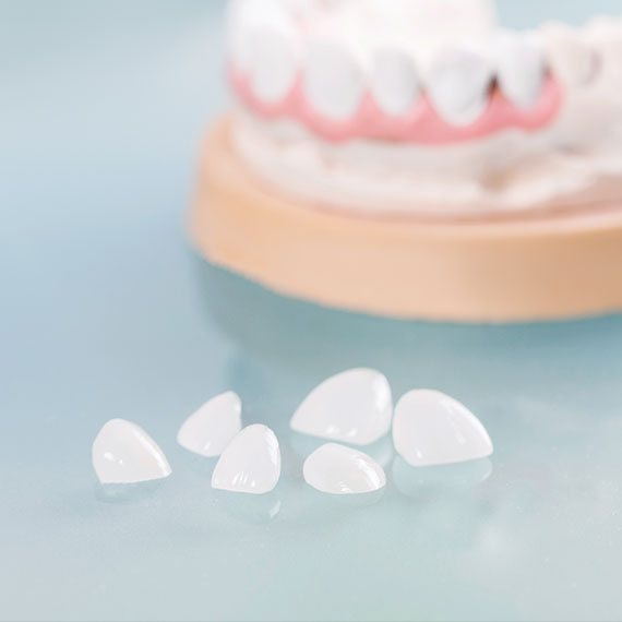 Porcelain veneers in Vancouver
