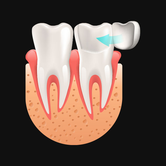 Porcelain veneers near you