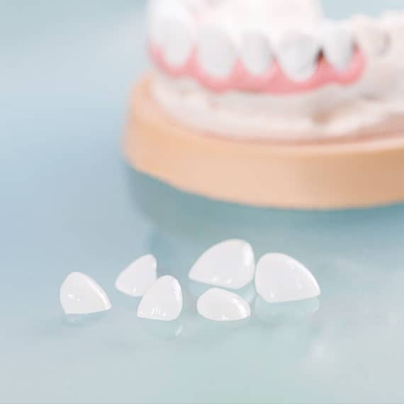 Porcelain veneers in Vancouver