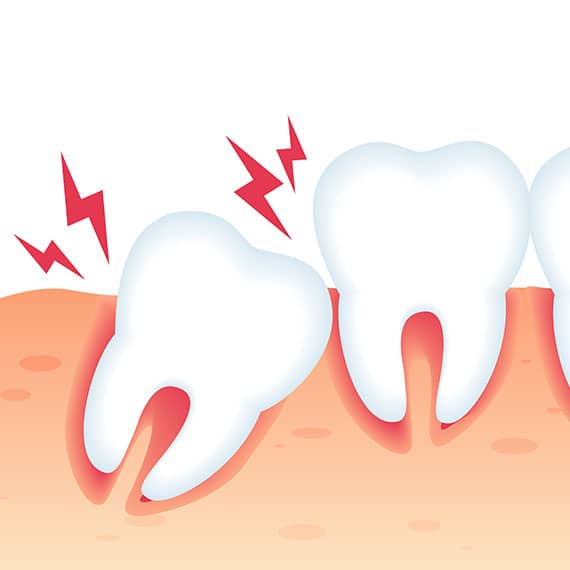 Wisdom tooth extractions in Vancouver