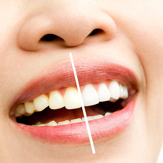 teeth whitening treatment