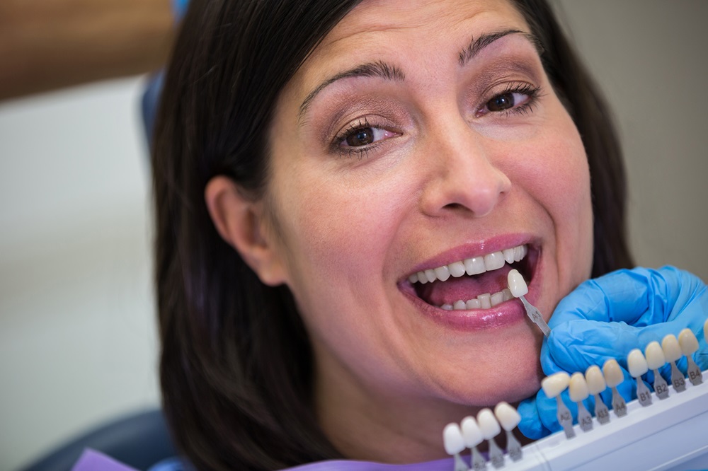 Porcelain Veneers in Vancouver