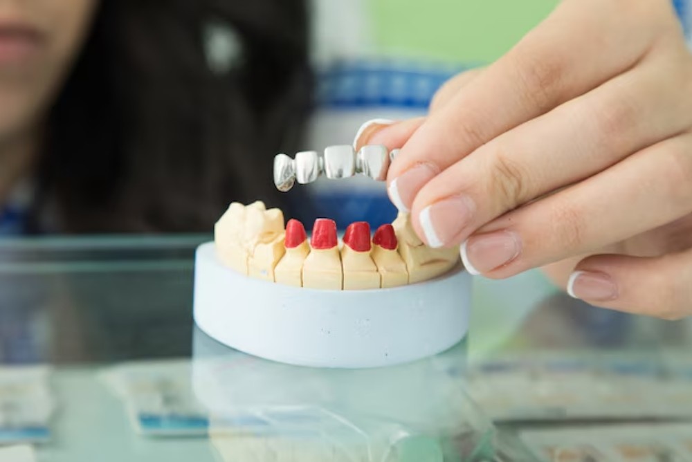 Dental Bridges in Vancouver