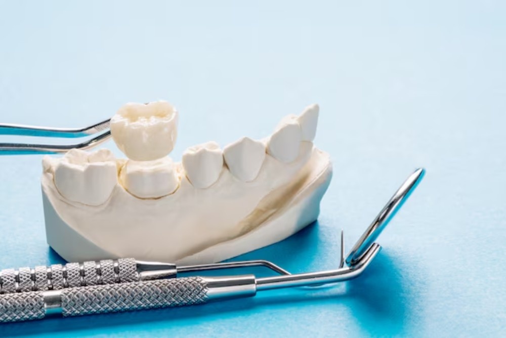 Dental Bridges Near You