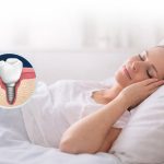 How Many Days Should I Rest After a Dental Implant?
